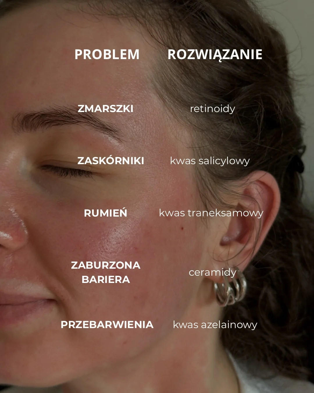 Problemy skórne i ich rozwiązania - zmarszczki, zaskórniki, rumień, zaburzona bariera
