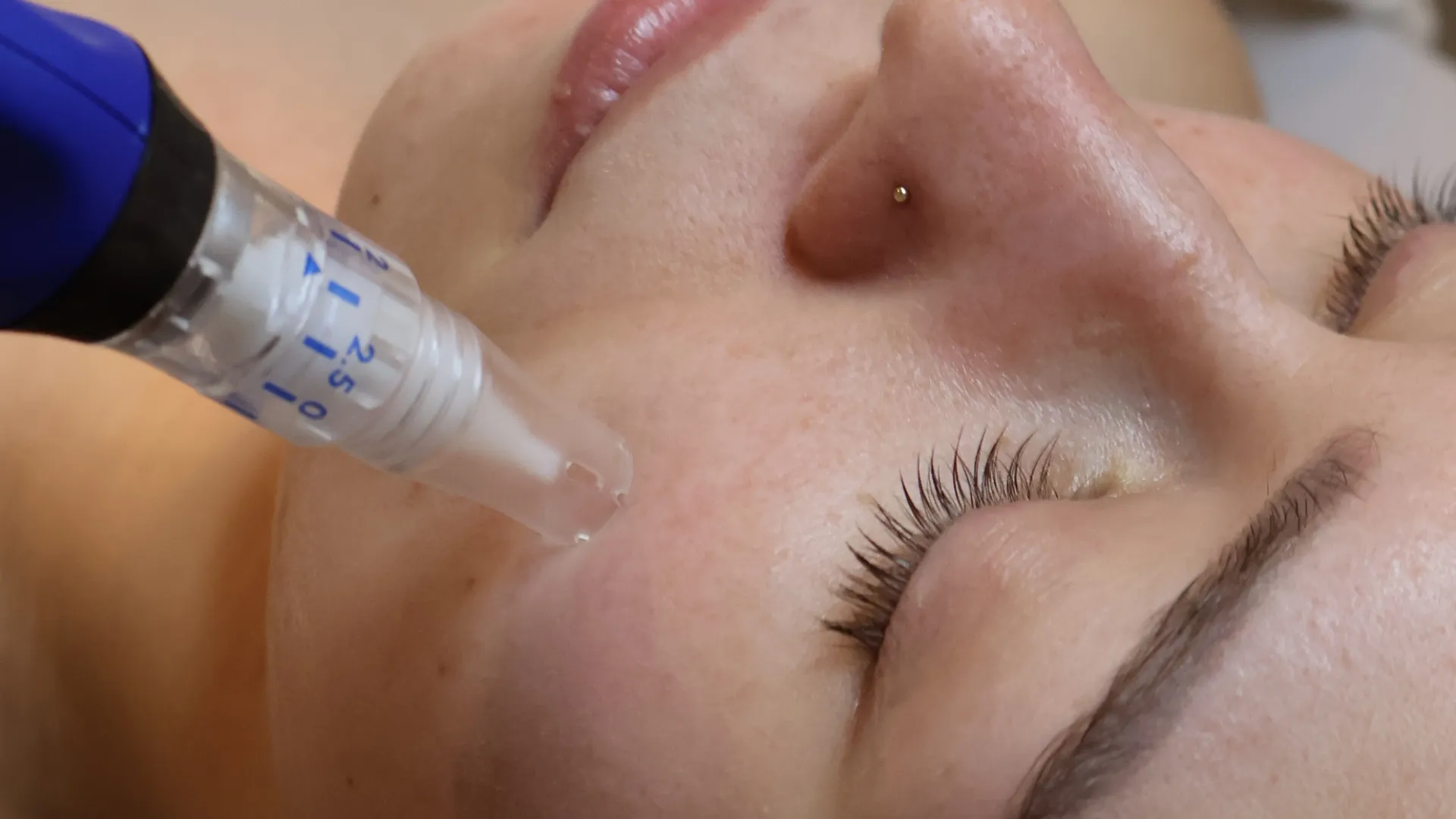 Gabinet kosmetologiczny w Zielonce — zabieg mezoterapii mikroigłowej